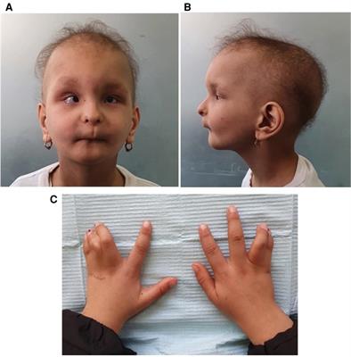 Hallermann–Streiff syndrome: Case report with abnormal pulp calcifications